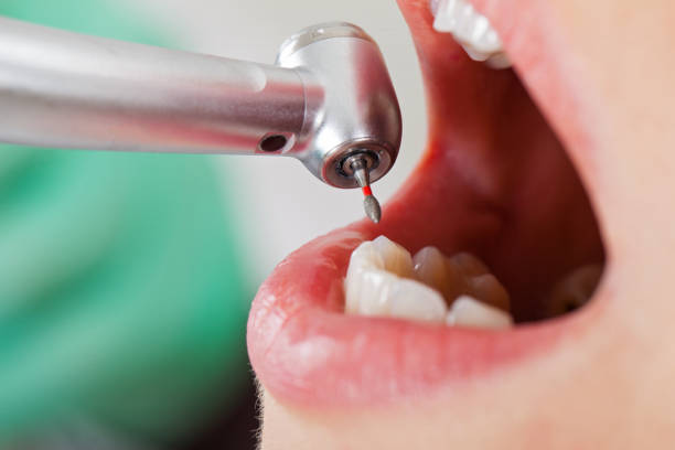 Best Emergency Treatment for Dental Infections or Abscesses in Bee Ridge, FL